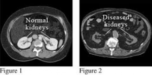 Picture of normal kidneys and diseased kidneys on a CT scan