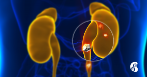 Image of a kidney stone obstructing the ureter to demonstrate the integrative approach to kidney stones