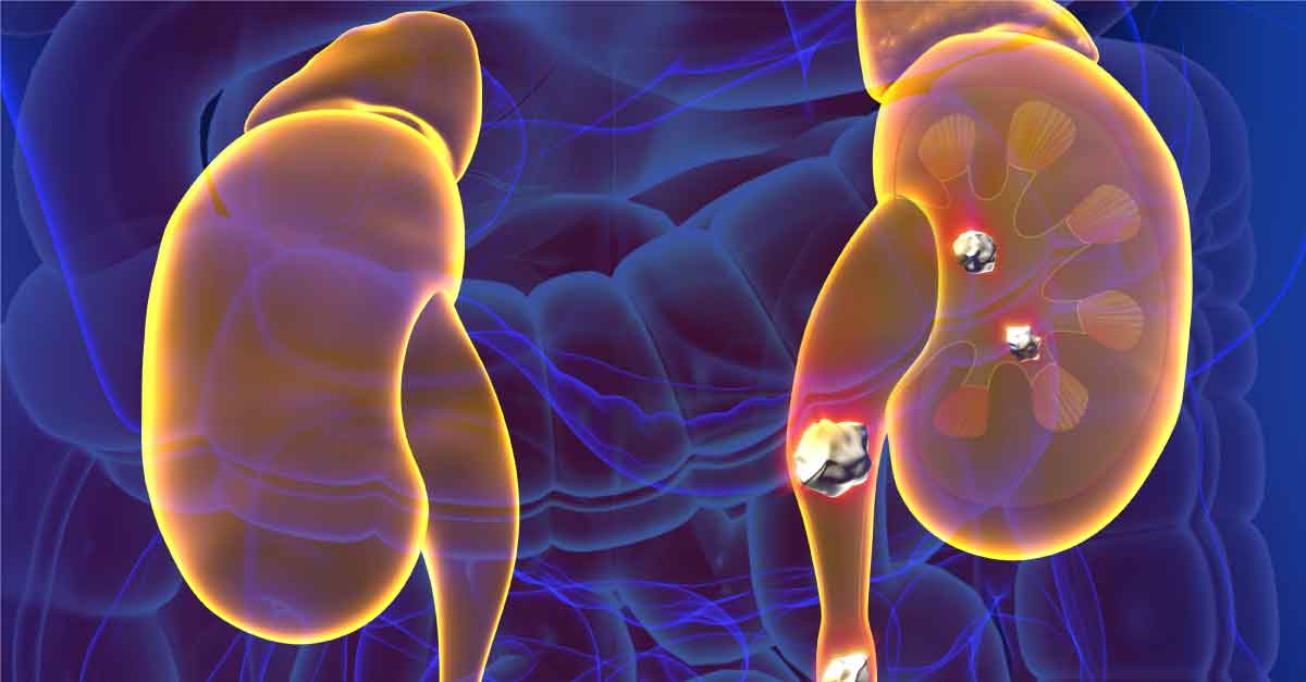 The Microbiome and Kidney Stone Formation — Integrative Kidney